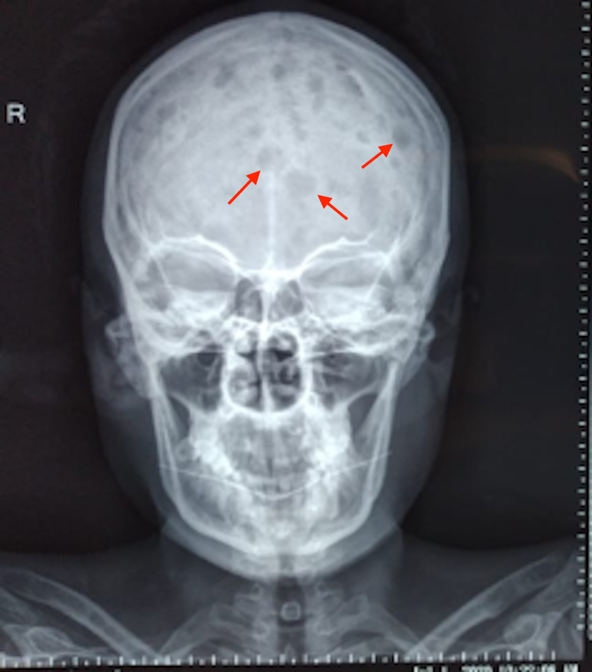 Multiple Myeloma Skull / Multiple myeloma affecting the skull base ...