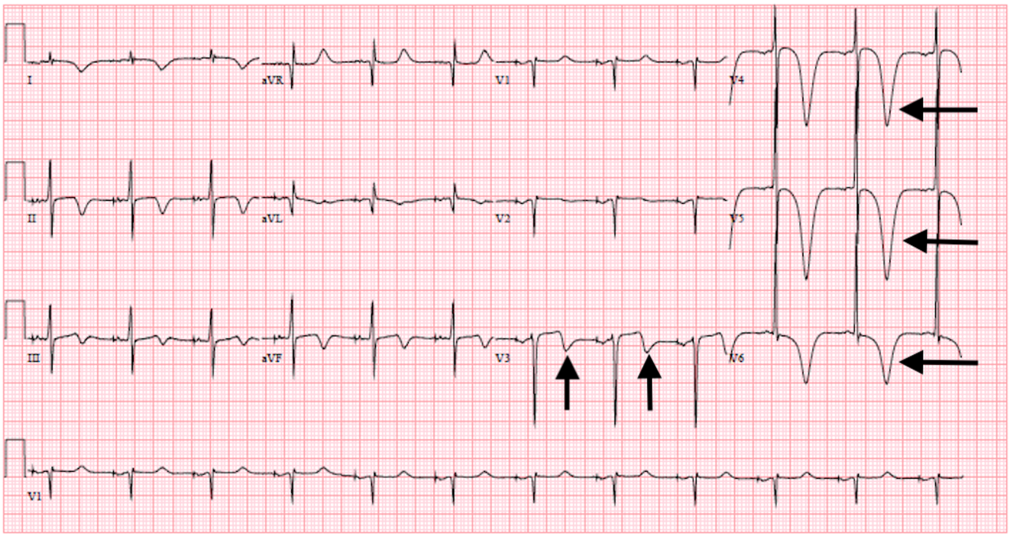 Wellens Syndrome Ekg Trauma