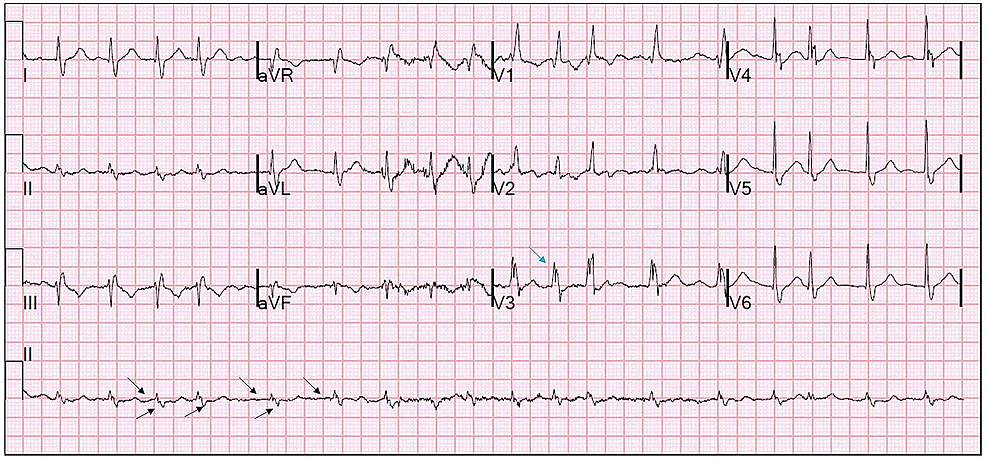 Cureus | A Case of Isolated Dysarthria in a COVID-19 Infected Stroke ...