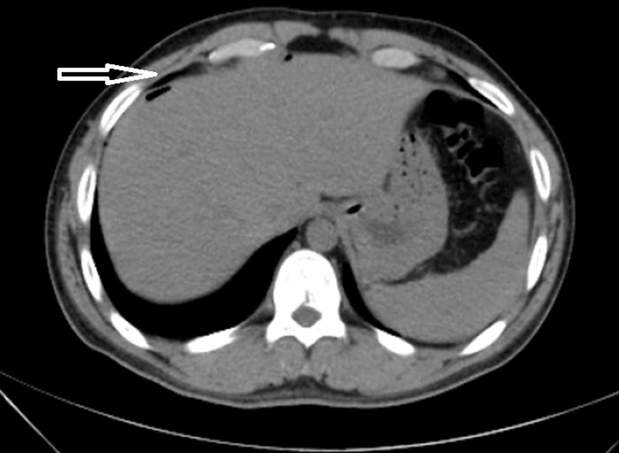 Cureus | Traumatic Acute Colonic Intramural Hematoma: A Rare Entity and ...