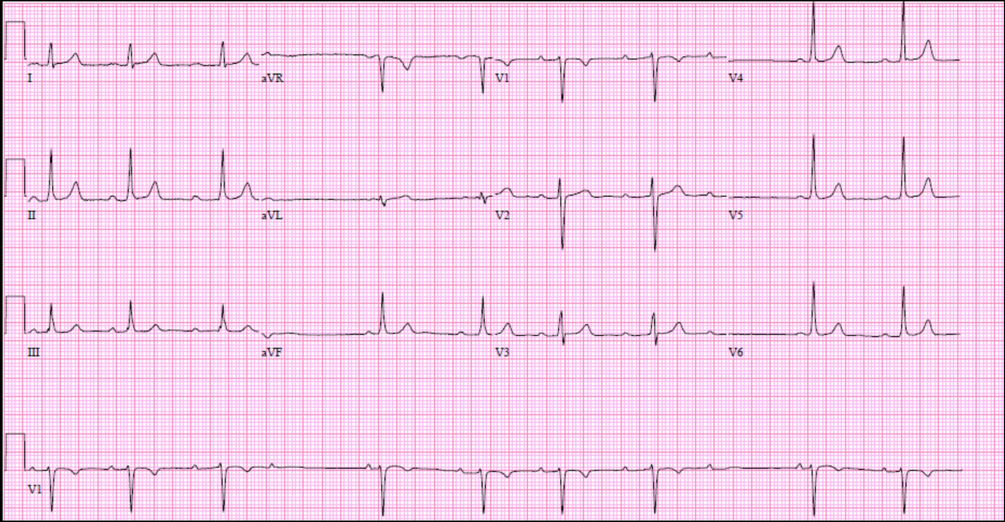 cureus-transient-second-degree-atrioventricular-block-a-rare-finding