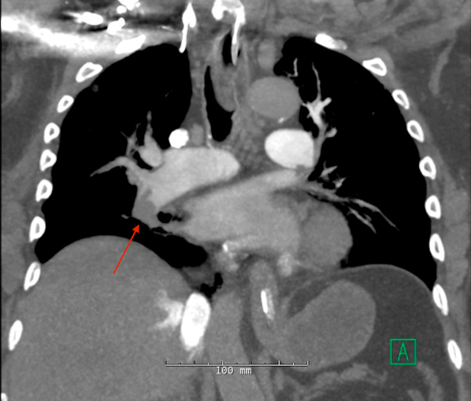 Cureus CatheterDirected Thrombectomy for Pulmonary Embolism in the
