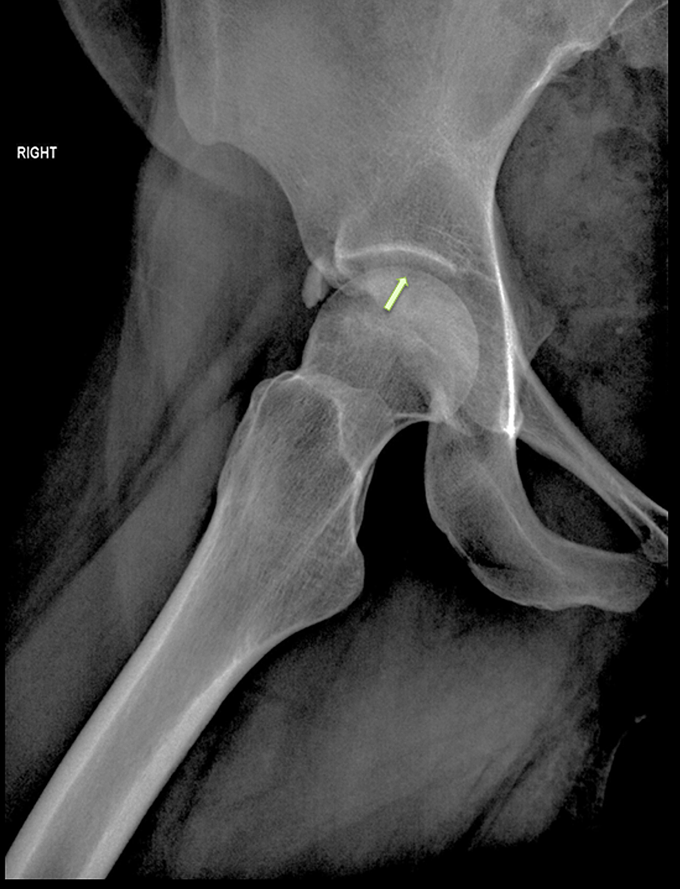 Cureus | Simultaneous Bilateral Avascular Necrosis of the Femoral Heads