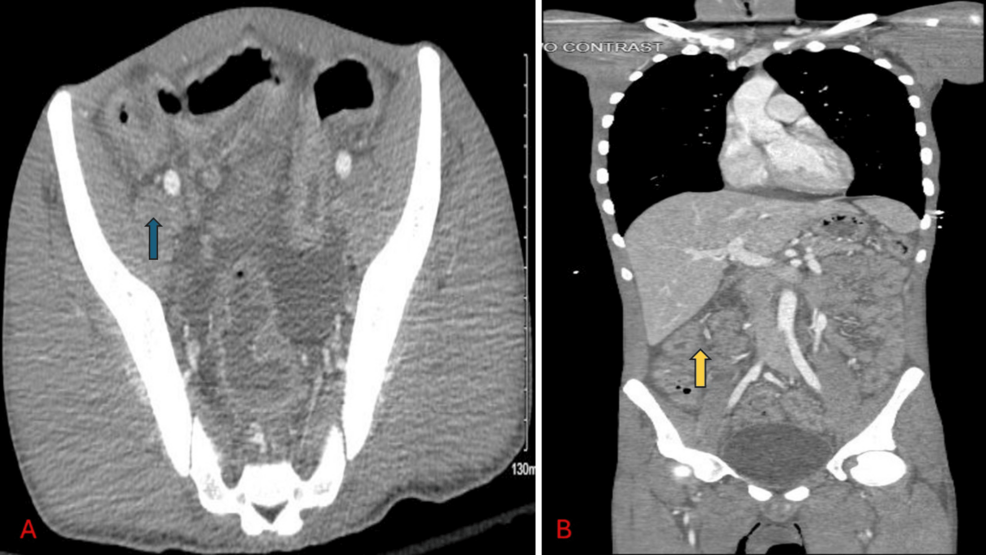潰瘍性大腸炎が不正になりました：炎症性腸疾患における補体媒介血栓性微小血管障害の症例