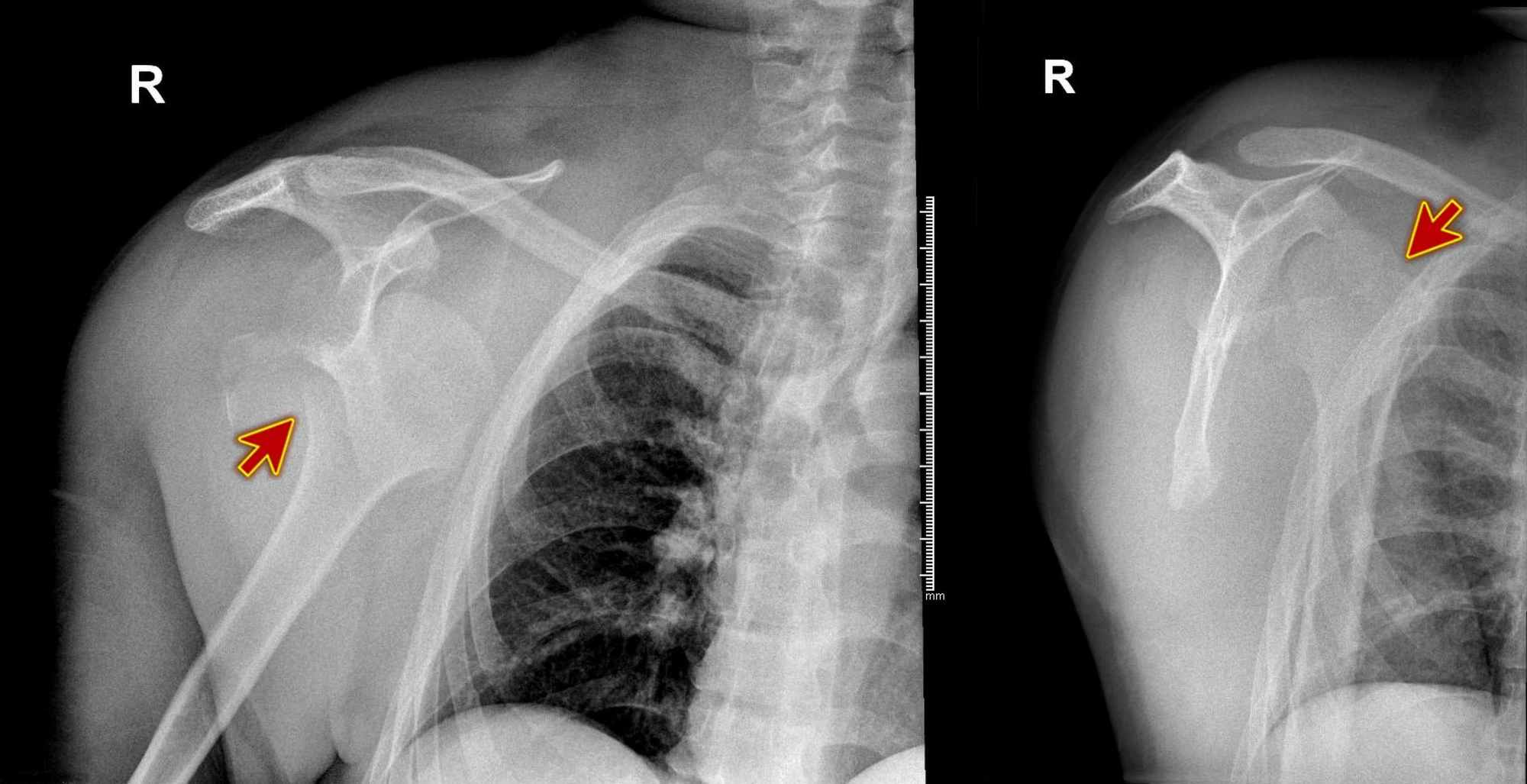 Icd 10 Code For Ge Junction Nodule