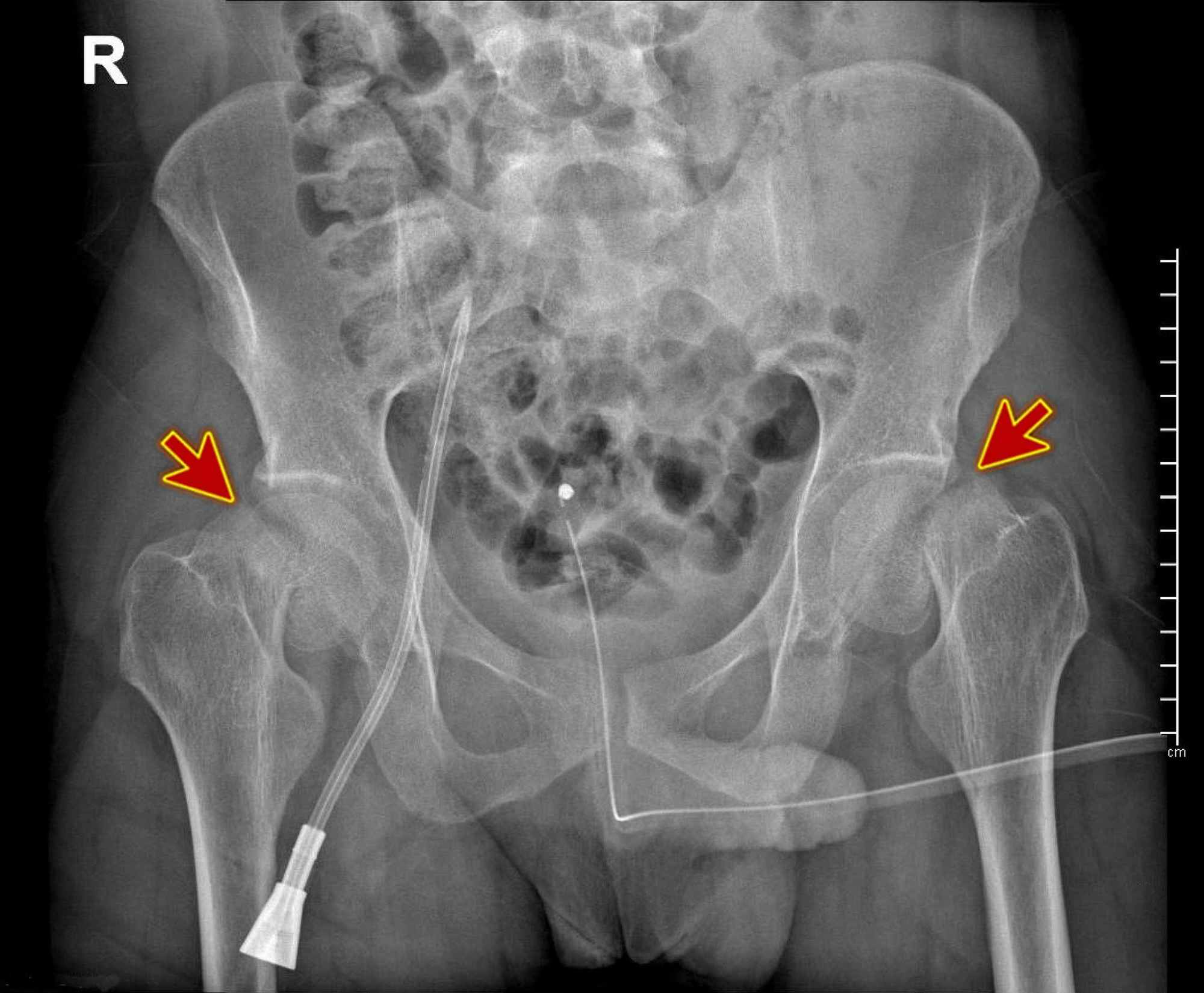 right femoral neck fracture