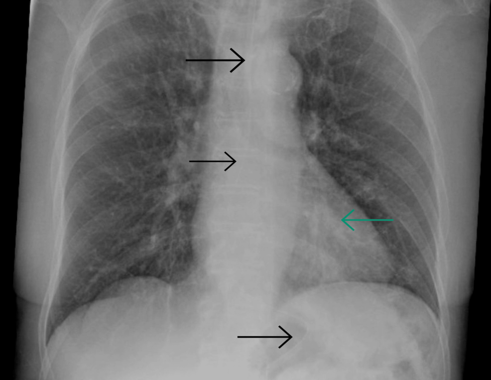 Chest-X-ray-showing-suspected-infiltrates-in-the-left-lower-lung-zone,-in-the-retrocardiac-location,-with-clear-costophrenic-angles.-Black-arrows-indicate-the-nasogastric-tube. Chest-X-ray-showing-suspected-infiltrates-in-the-left-lower-lung-zone,-in-the-retrocardiac-location,-with-clear-costophrenic-angles.-Black-arrows-indicate-the-nasogastric-tube.