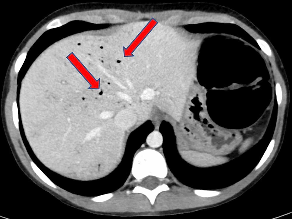 Cureus | Hepatic Portal Venous Gas Incidentally Associated With ...