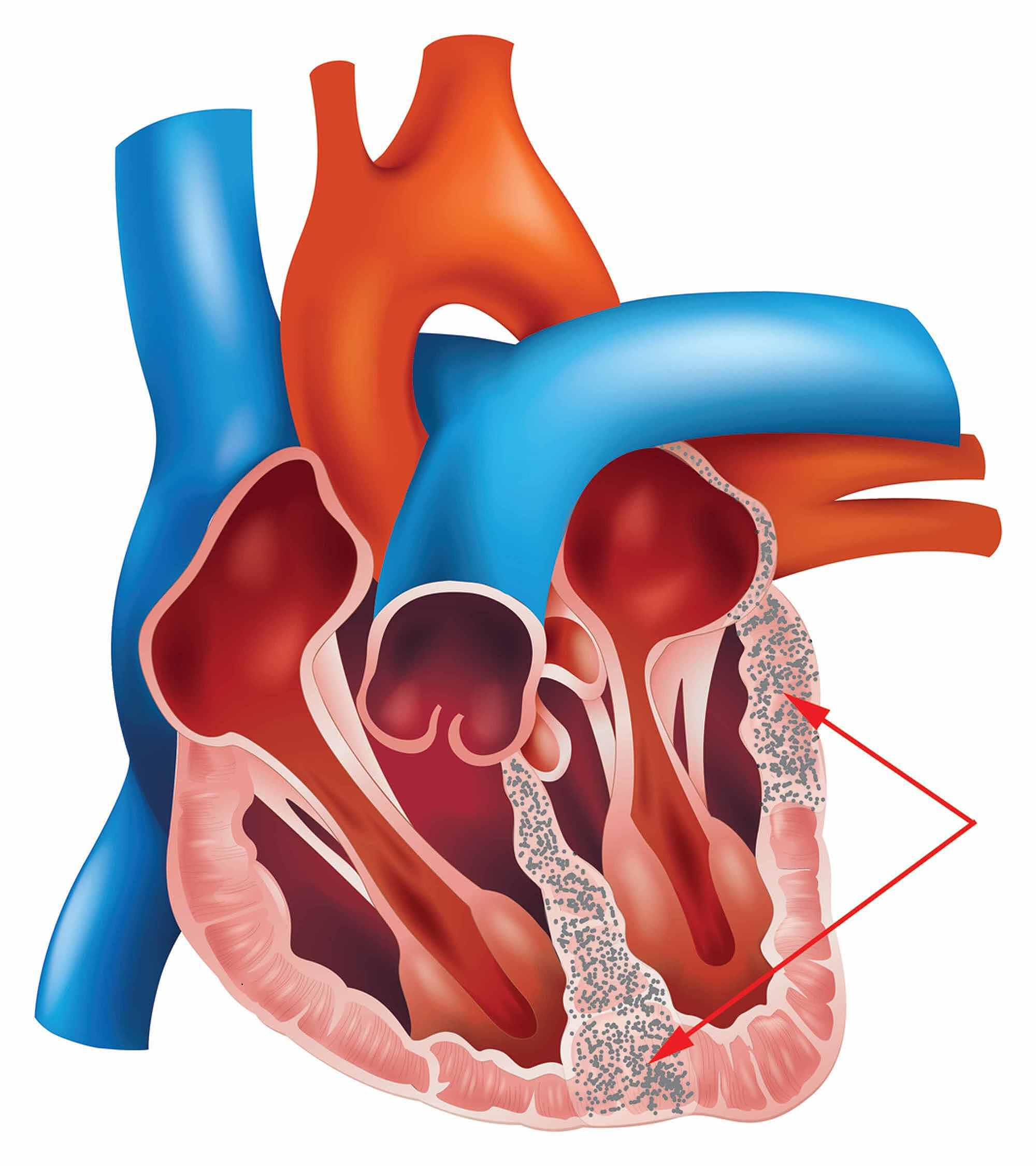 Cureus | Association of Arrhythmias in Cardiac Amyloidosis and Cardiac ...