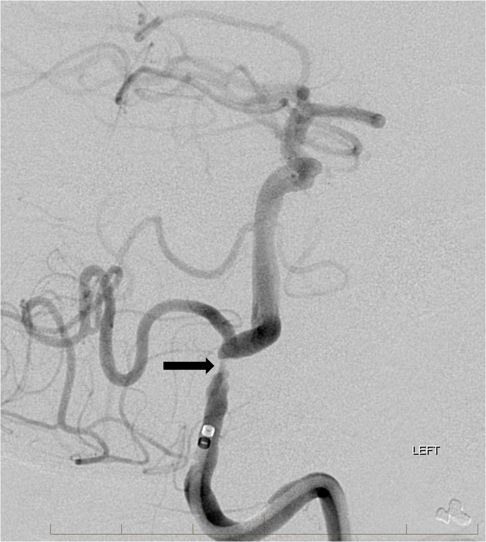 cureus-delayed-endovascular-stenting-for-severe-vertebral-artery