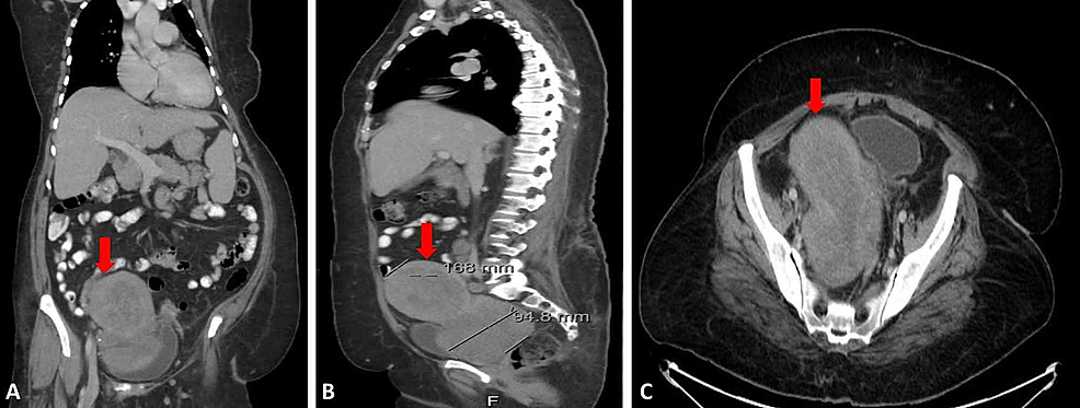 Cureus | Primary Uterine Rhabdomyosarcoma in a 54-Year-Old