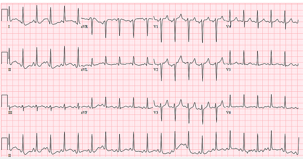 Case-1-electrocardiogram-on-admission-(April-11,-2020)