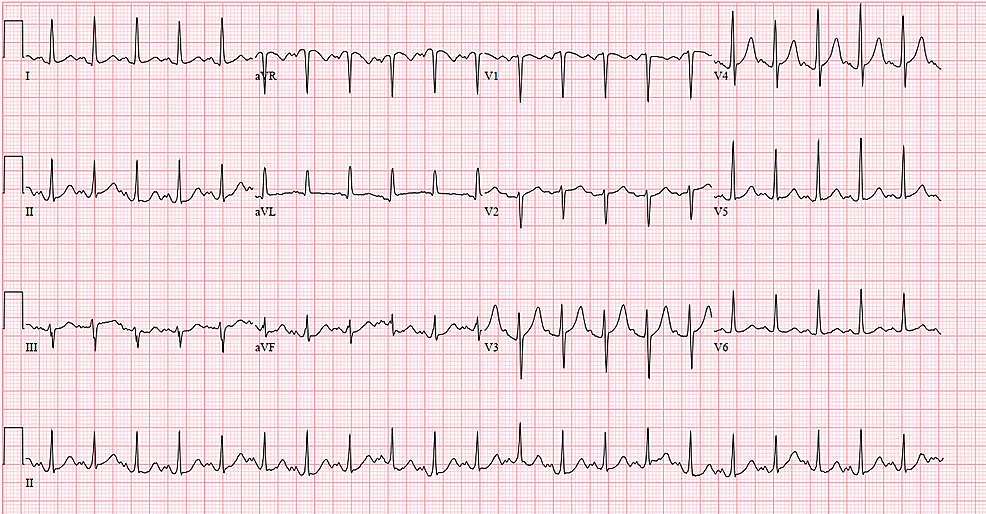 Case-2-electrocardiogram-on-admission-(April-03,-2020)