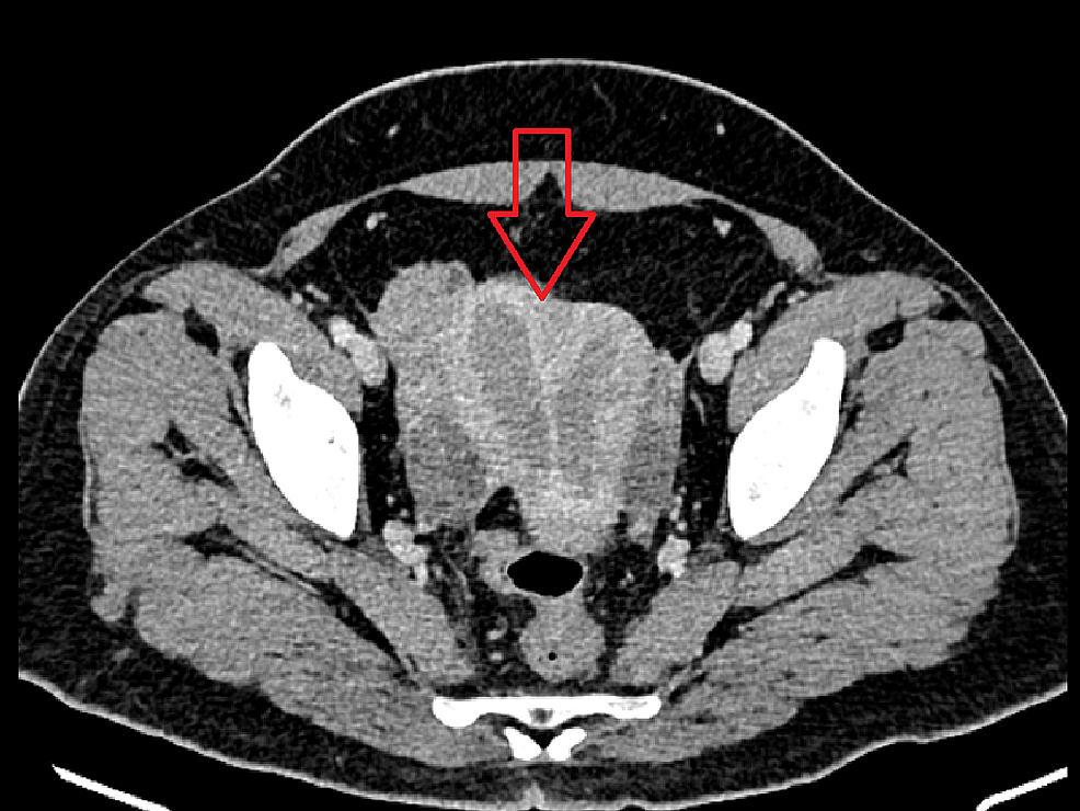 Cureus Rare Case Report of an Endometrial Adenocarcinoma Arising in a