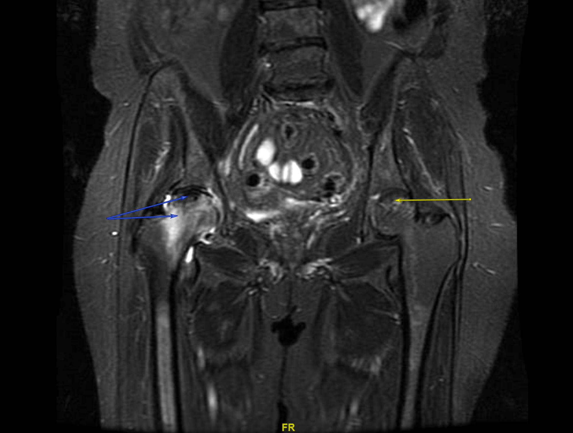 Cureus Avascular Necrosis of Both Hips From Iatrogenic Cushing ’s