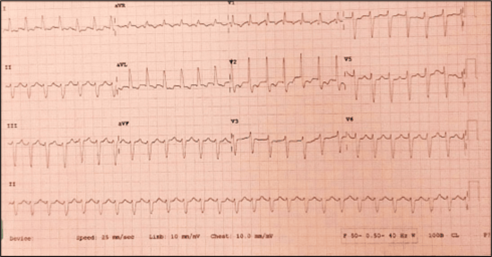 Revolutionizing Acute Pulmonary Thromboembolism Management with Endovascular Techniques