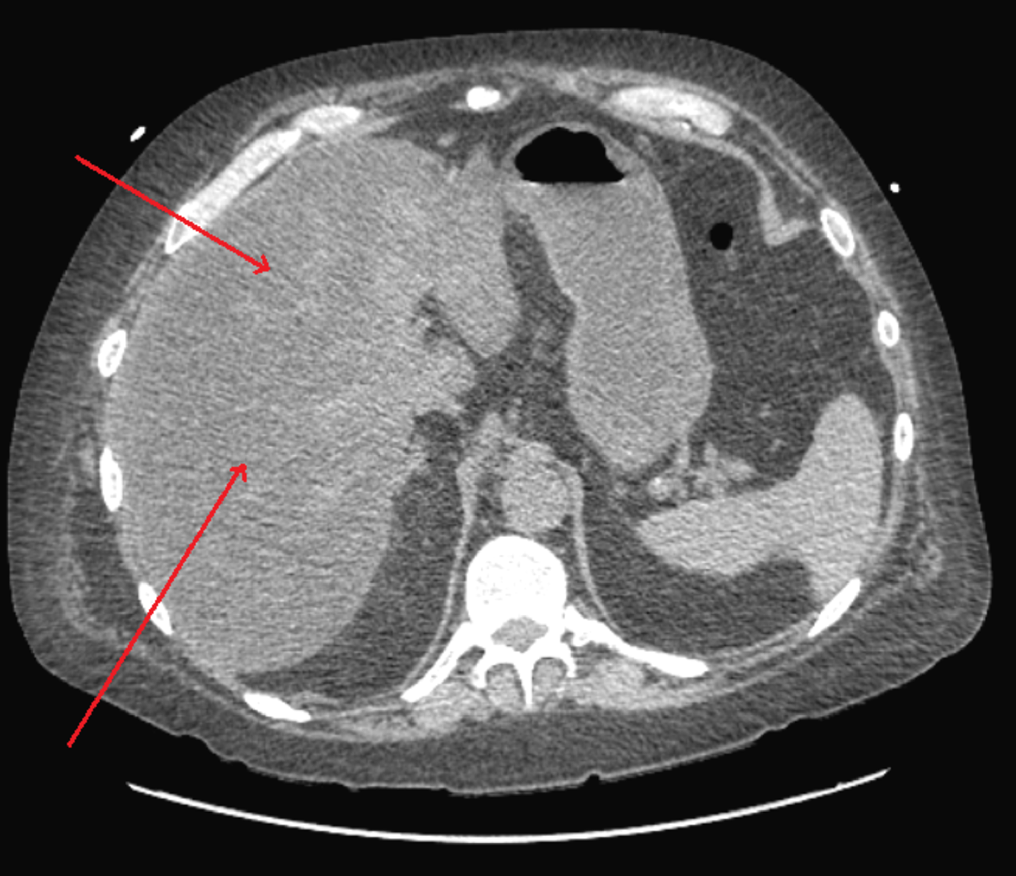 cureus-rare-case-of-leukemoid-reaction-in-a-patient-with-severe