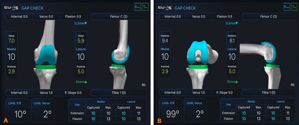 Gap Balancing Technique With Functional Alignment in Total Knee ...
