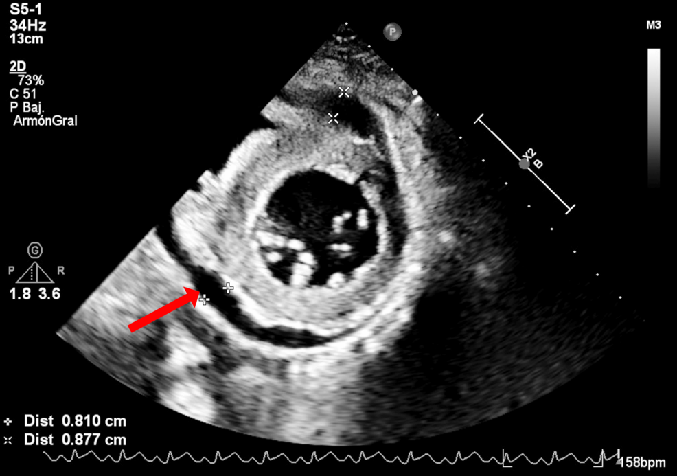 静脈動脈体外膜酸素化（VA-ECMO）を必要とする青年期の劇症インフルエンザB型心筋炎：メキシコの小児心臓紹介センターで完全回復