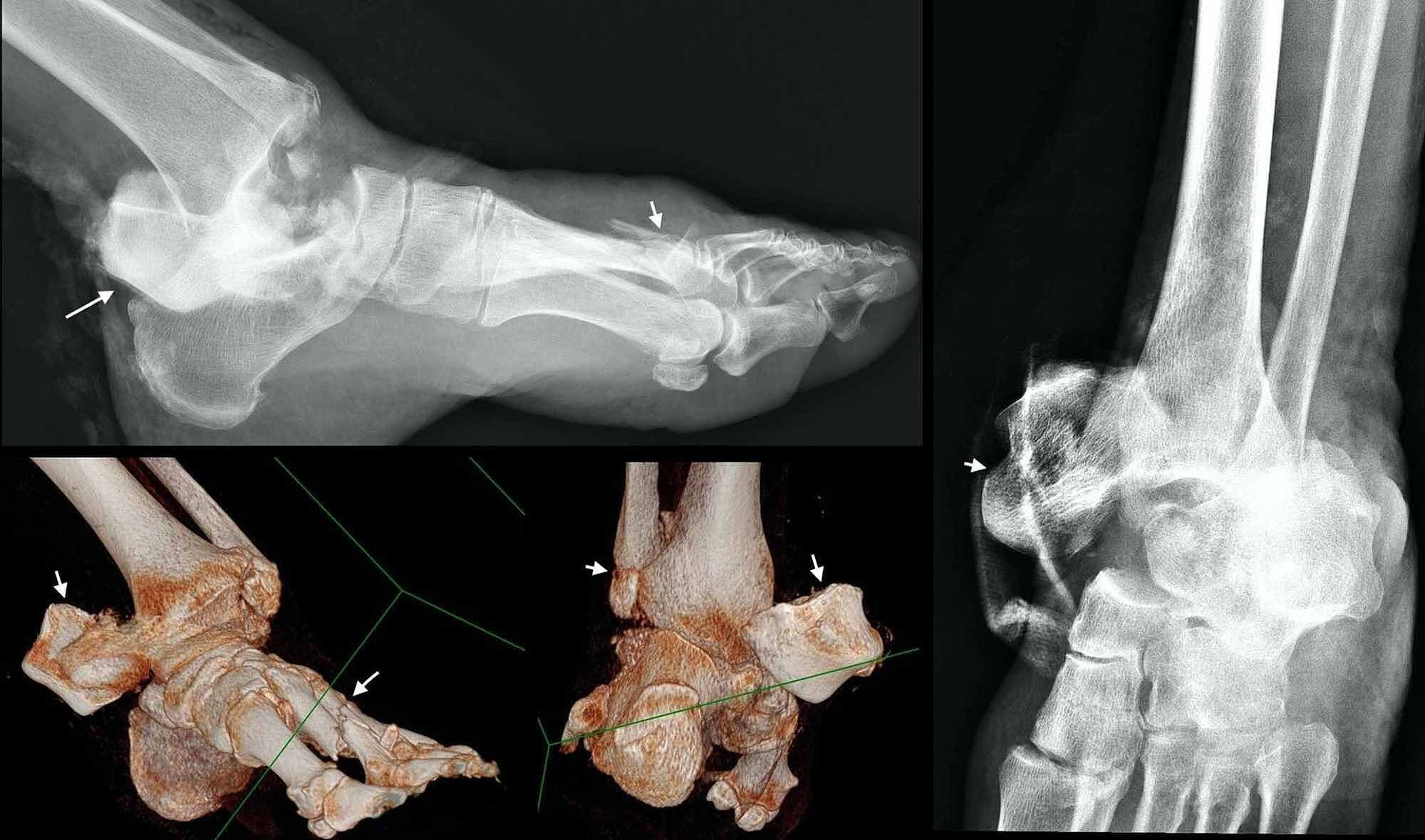 Cureus | Outcomes of a Reimplanted Talus After a Total Open Extrusion