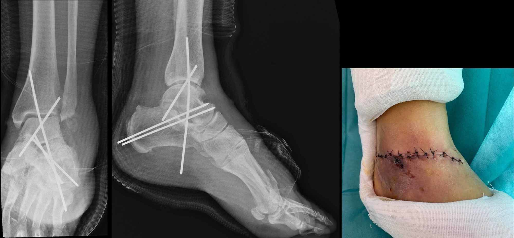 Cureus | Outcomes Of A Reimplanted Talus After A Total Open Extrusion