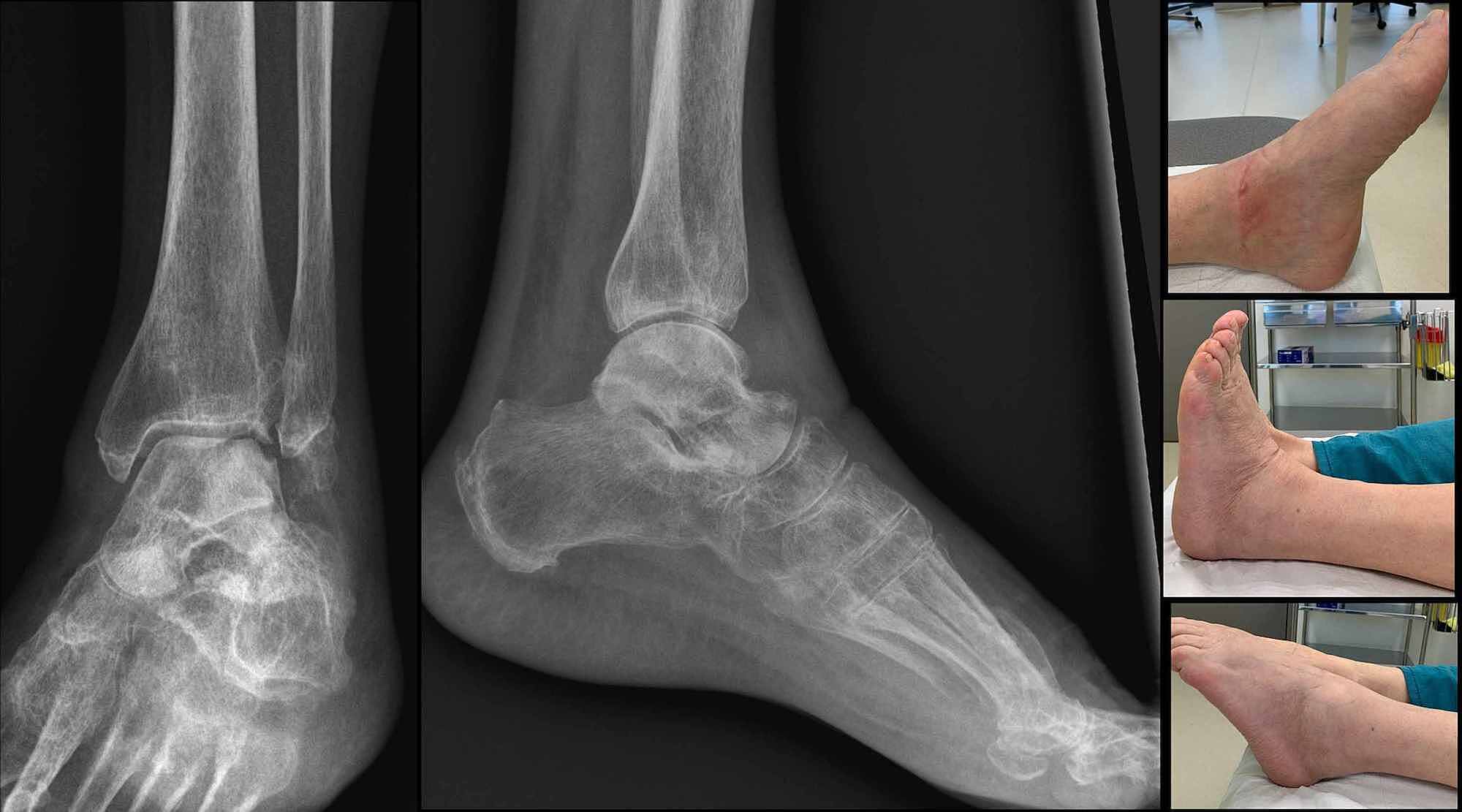 Cureus of a Reimplanted Talus After a Total Open Extrusion