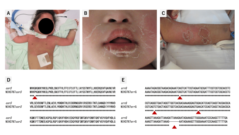 Toxic Shock Syndrome Caused by Streptococcus dysgalactiae Subspecies equisimilis: A Rare Pediatric Case