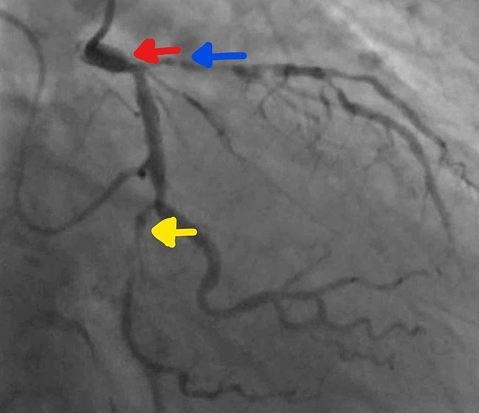 cureus-percutaneous-intervention-of-iatrogenic-iliac-artery-vascular