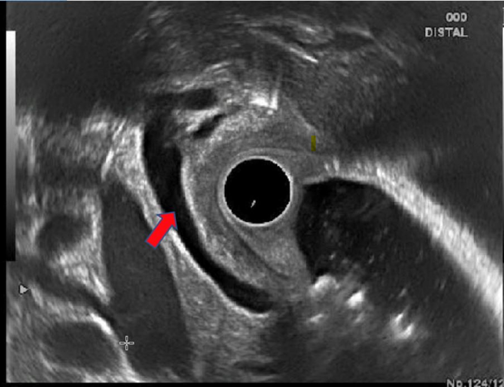 Cureus Emphysematous Cholecystitis and Necrotizing Pancreatitis