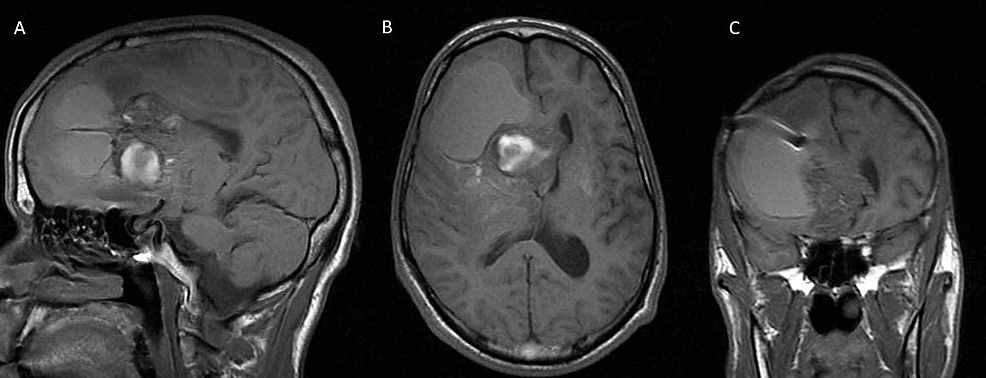 Cureus, Brainstem and Spinal Arachnoiditis Ossificans Associated With  Neurocysticercosis: A Case Report