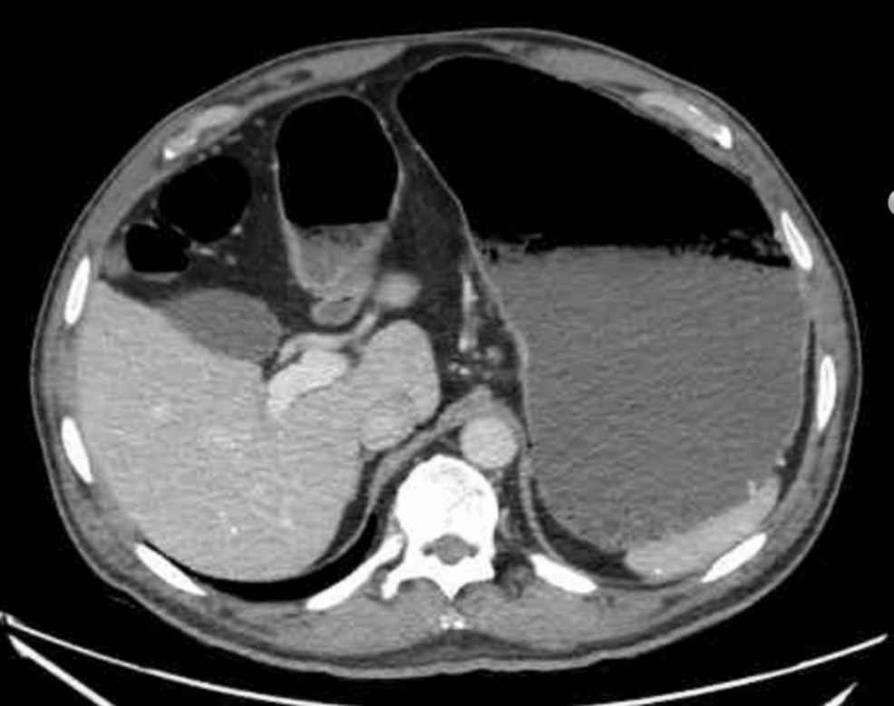 tirzepatide bowel obstruction Acute Functional Gastric Outlet Obstruction Associated With Low-Dose  Tirzepatide