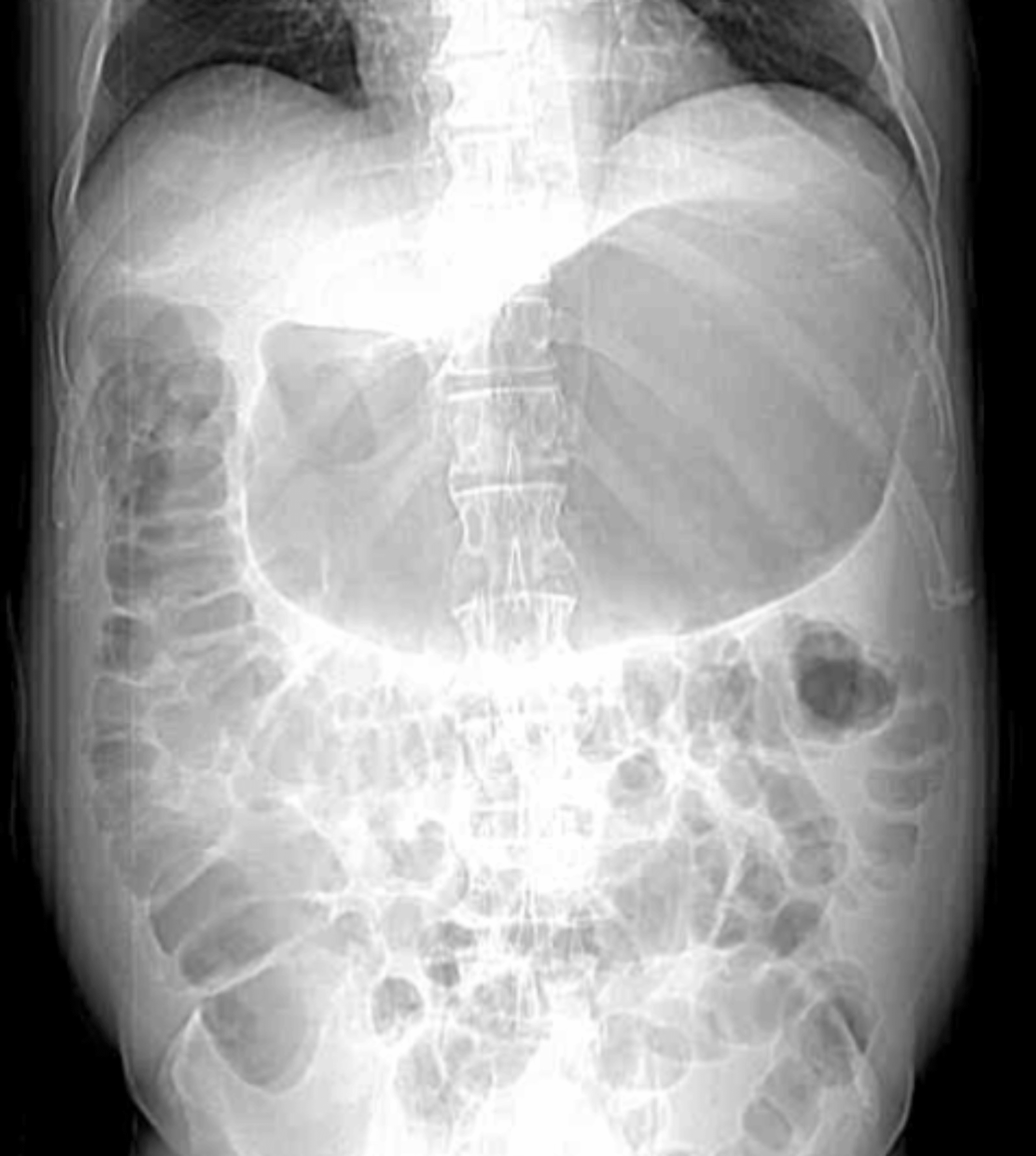 Acute Functional Gastric Outlet Obstruction Associated With Low-Dose  Tirzepatide