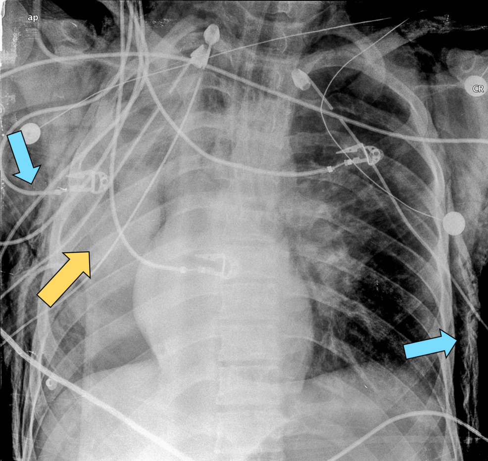 Spiral Bronchial Rupture in a Young Trauma Patient: Bronchoscopy and Surgical Precision