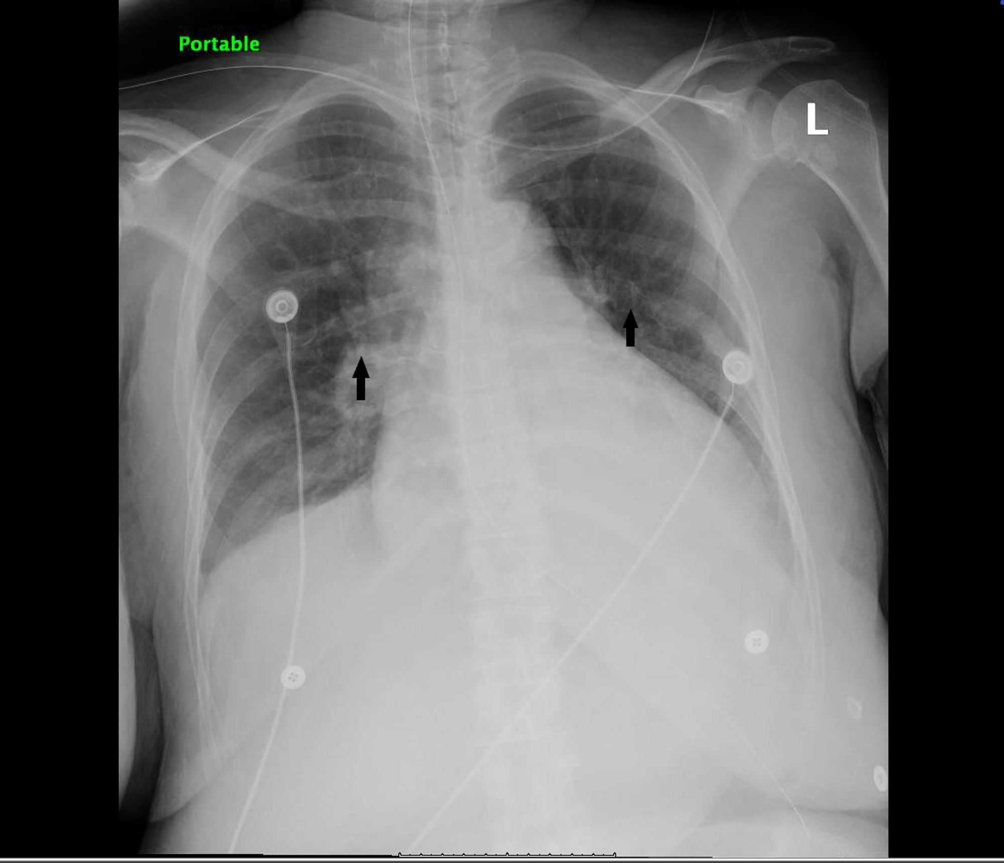 Cureus An Unusual Case of Bilateral Hemorrhagic Chemosis in the