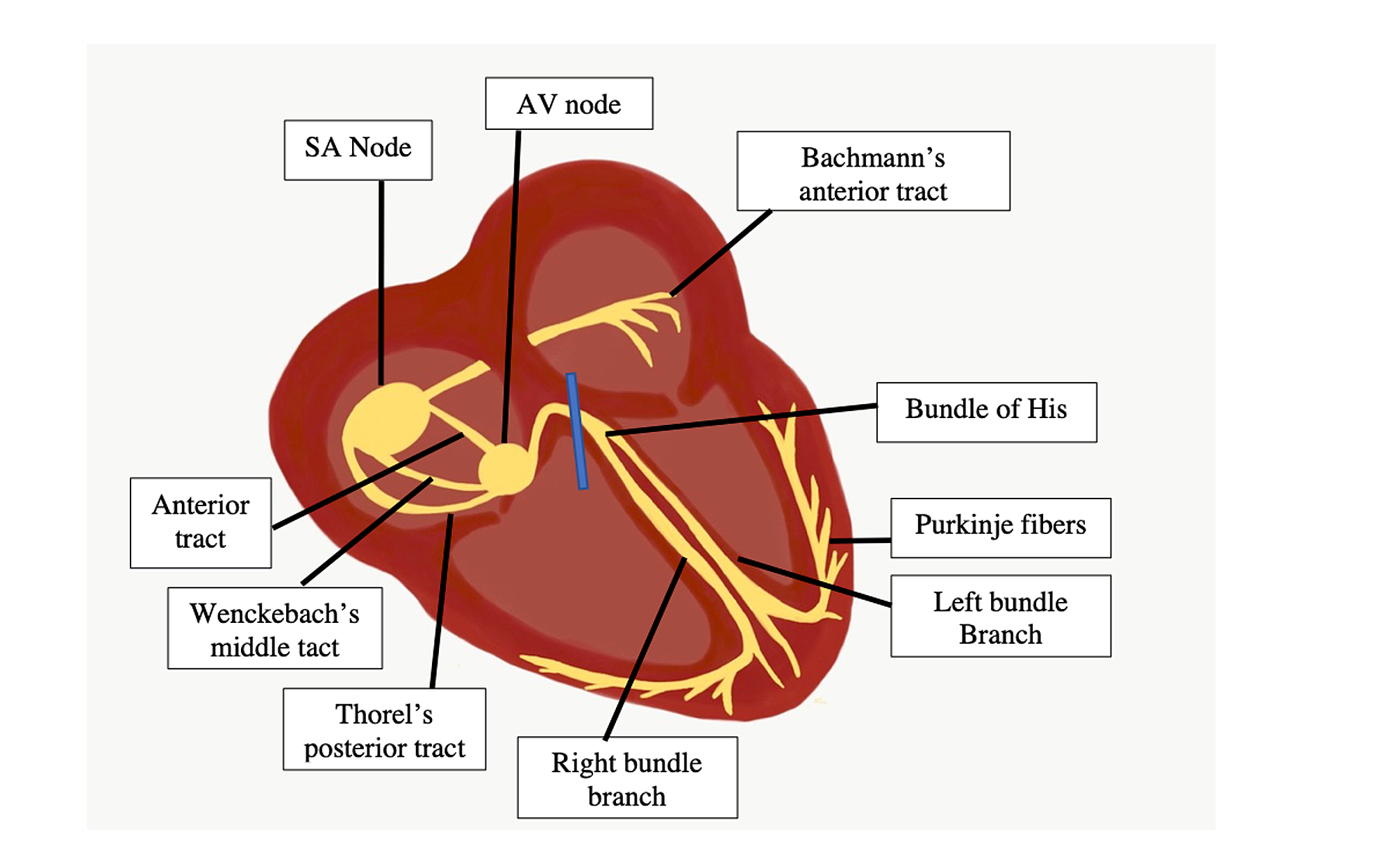 Cureus Atrioventricular Block in Pregnancy 15.8 Seconds of Asystole