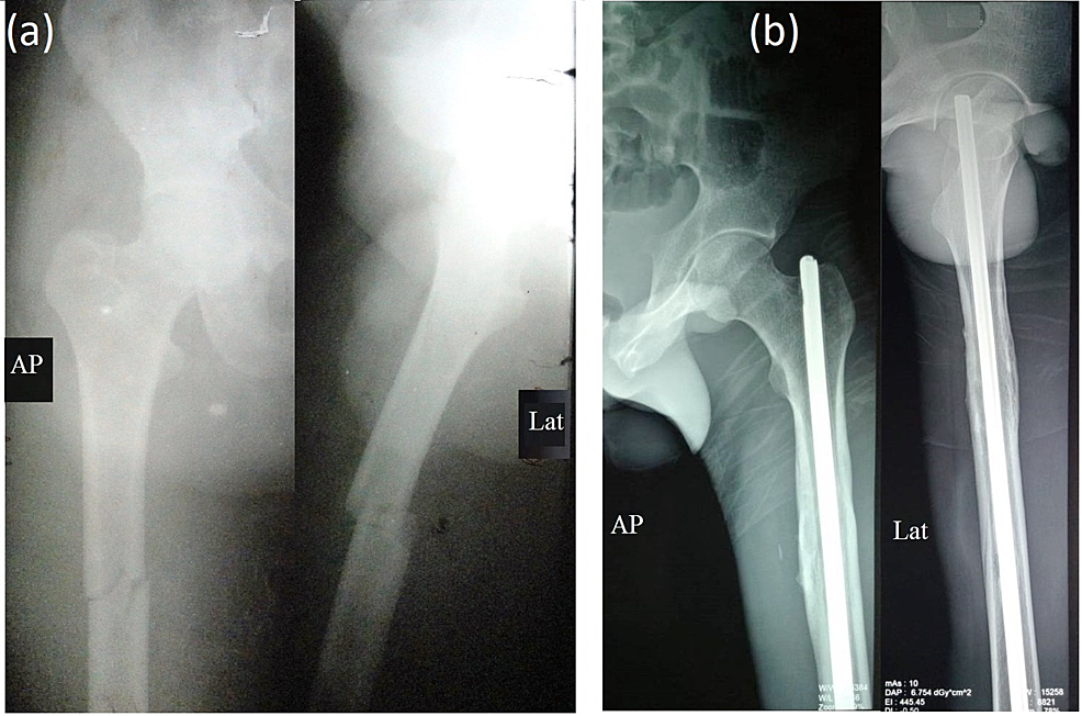 PDF] Exchange Nailing as Revision Surgery for Post-operative Non-union of  Atypical Femoral Fractures: A Case Report and Treatment Strategy | Semantic  Scholar