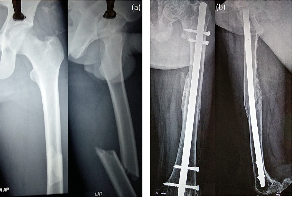 Cureus | Kuntscher Nail: A Forgotten Entity Yet a Reliable Modality in ...