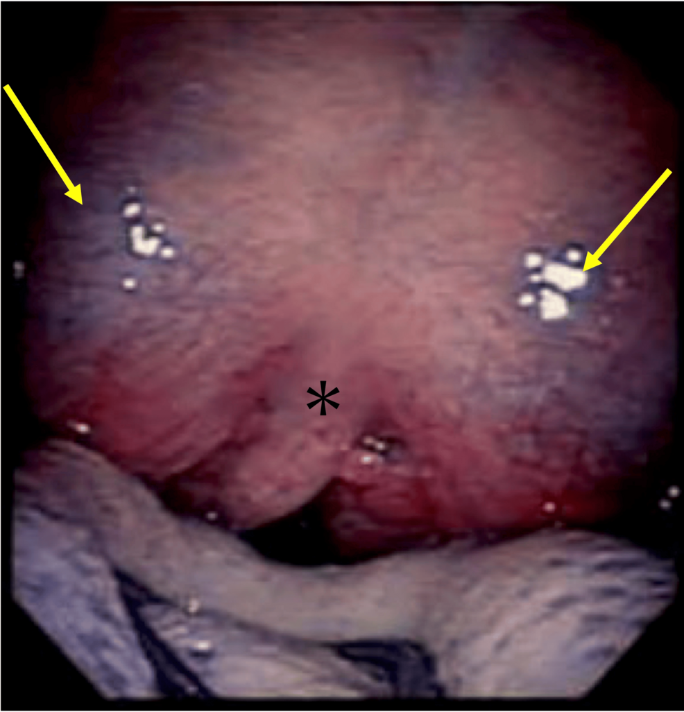 Bilateral Peritonsillar Abscesses Subsequent to COVID-19: A Case Report