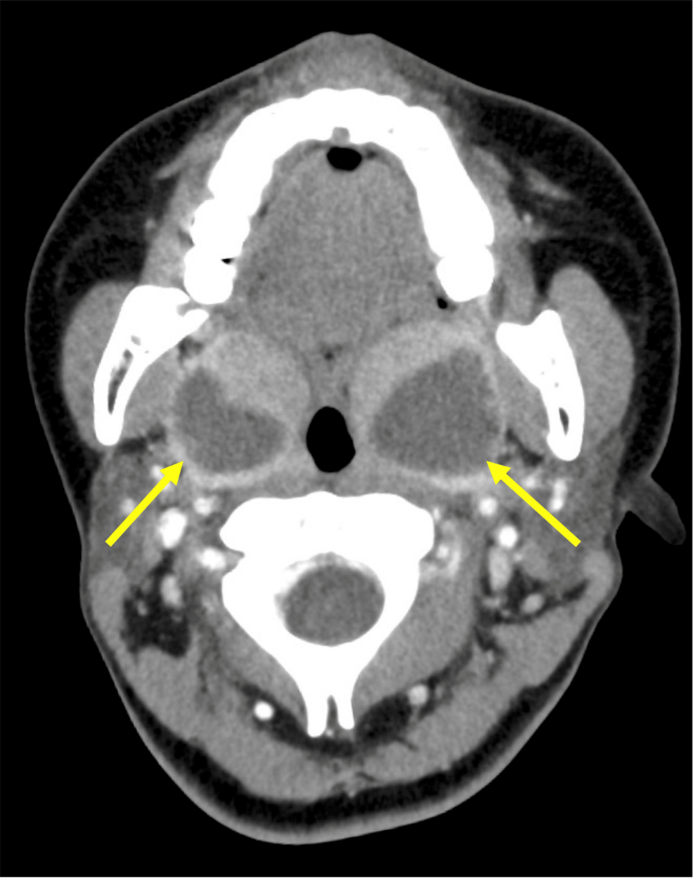 CT-findings-of-bilateral-peritonsillar-abscess