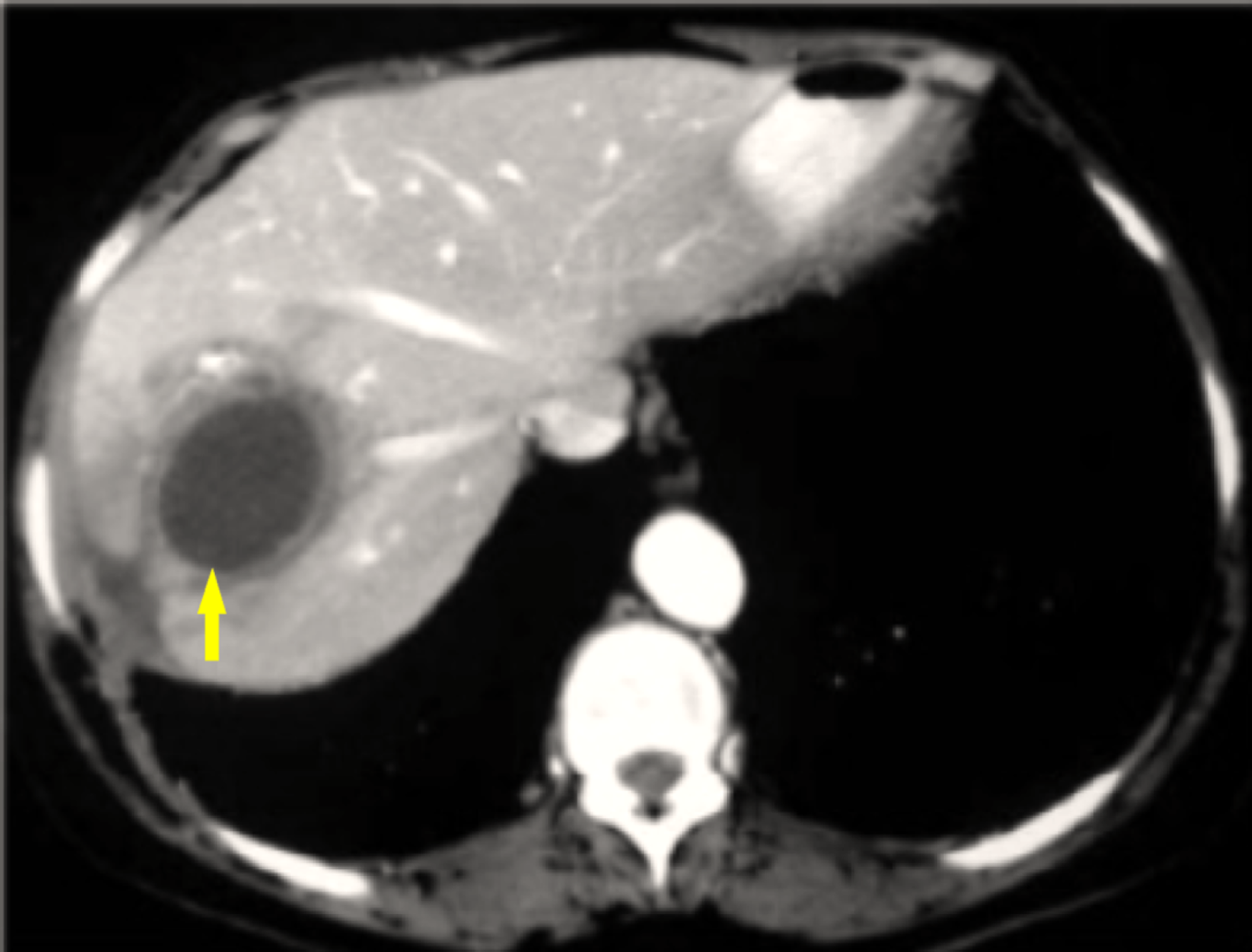 Cureus Pyogenic Liver Abscess and Sepsis Caused by Streptococcus