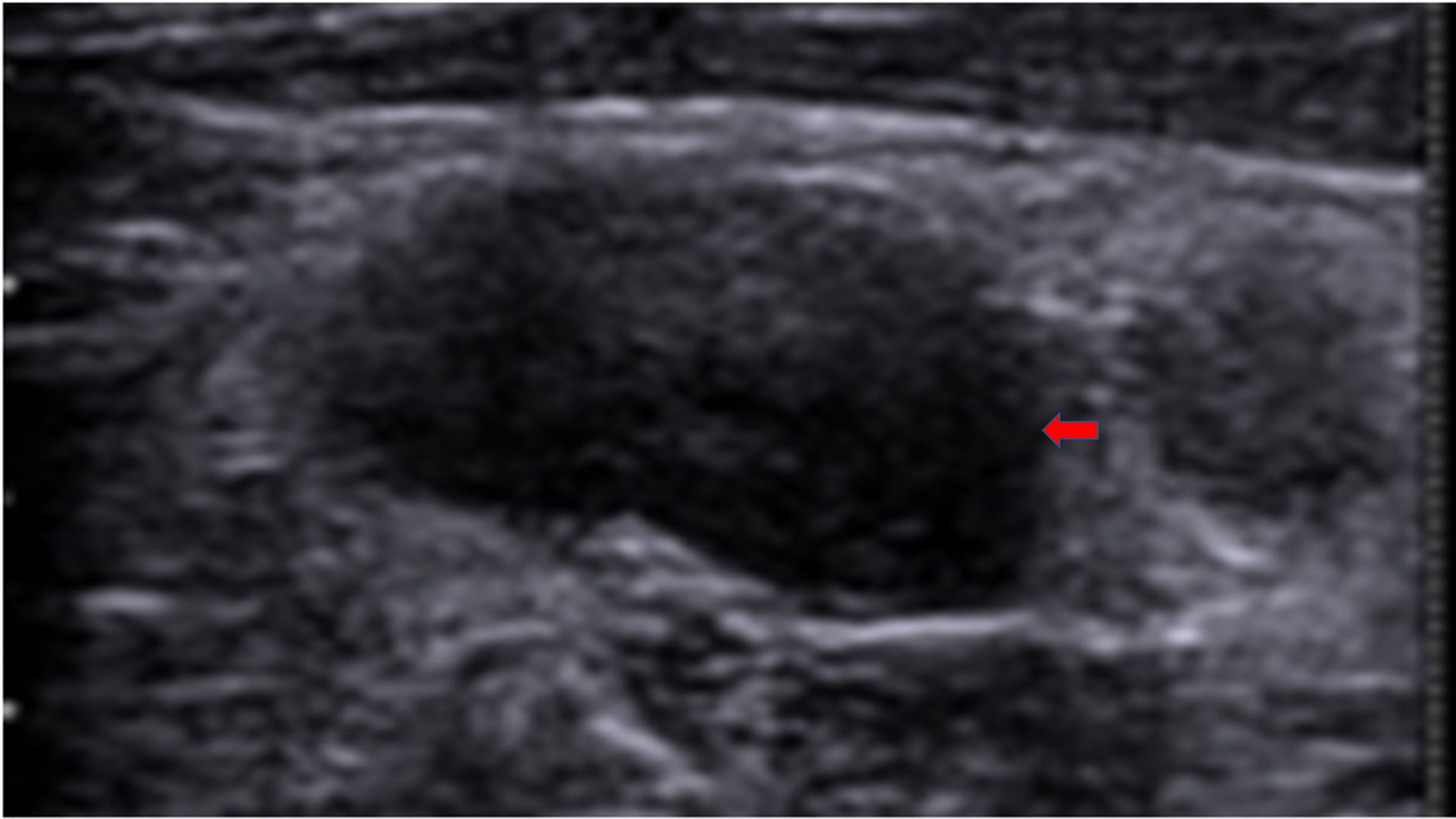 Cureus Evaluation Of B Mode And Color Doppler Ultrasound In The