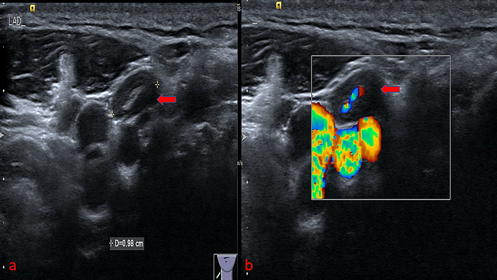 Cureus | Evaluation of B-Mode and Color Doppler Ultrasound in the ...