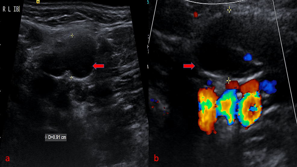 Cureus | Evaluation of B-Mode and Color Doppler Ultrasound in the ...