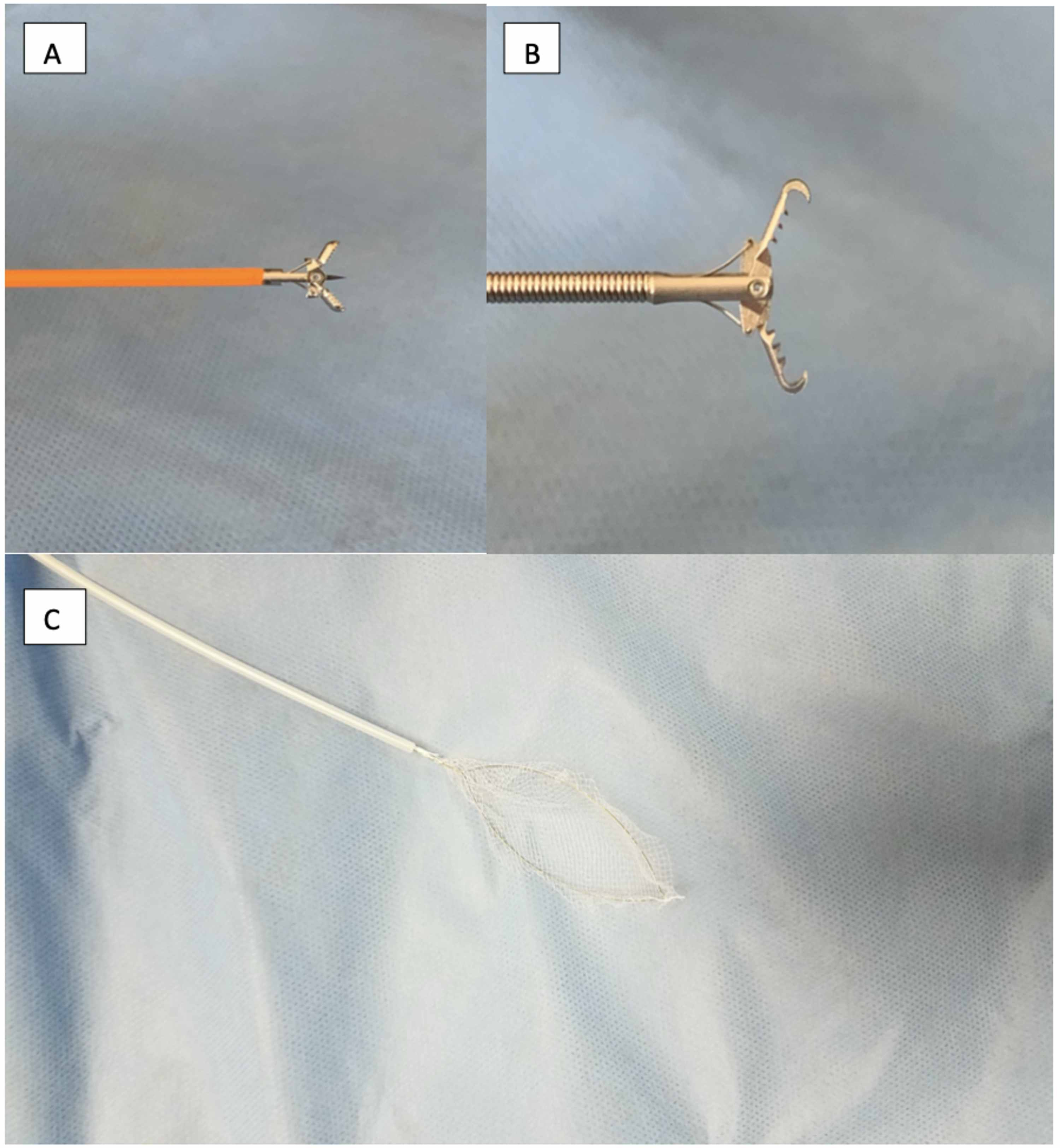 Cureus | Roth Net-Assisted Endoscopic-Guided Manometry Catheter Placement