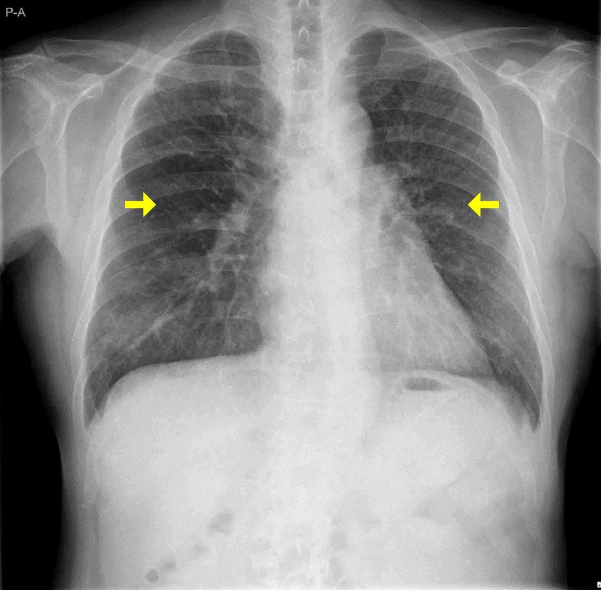 Cureus | Early Initiation of Awake Veno-Venous Extracorporeal Membrane ...