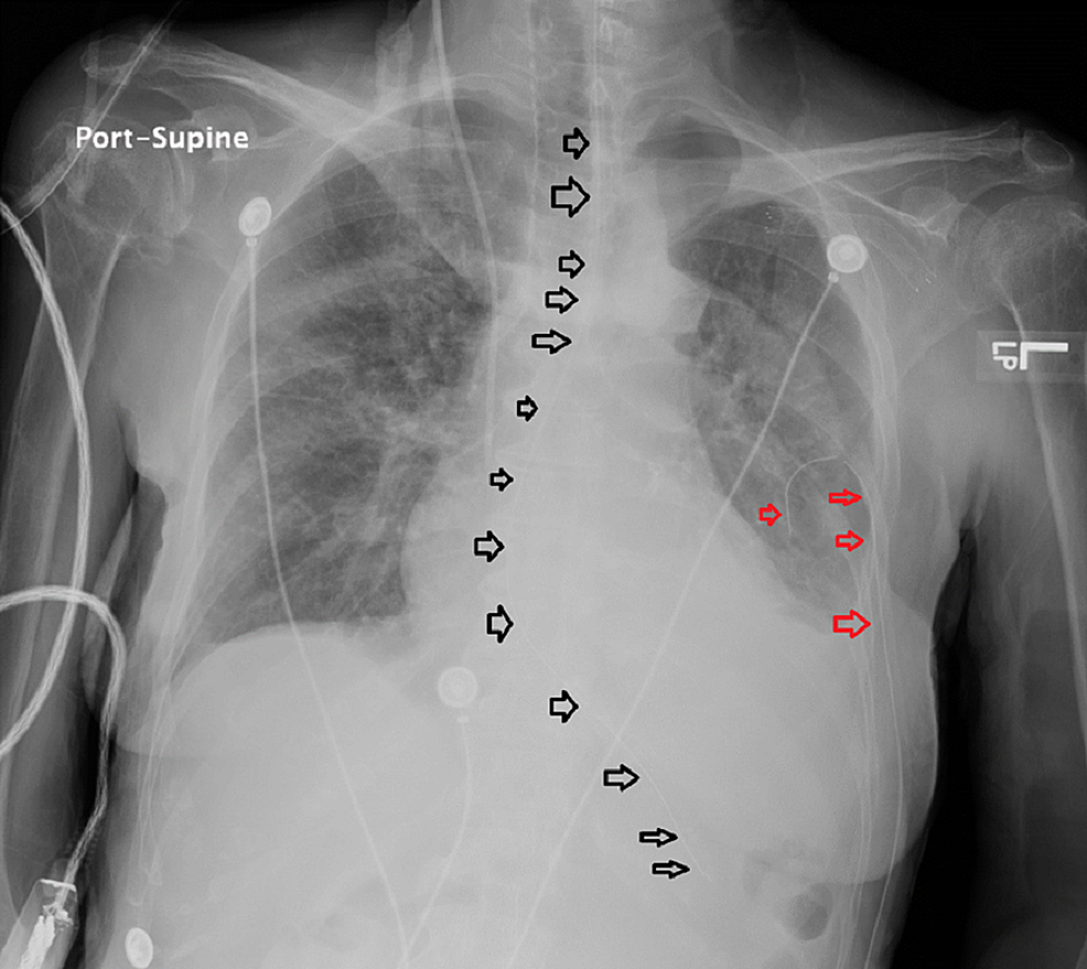 Cureus Using VideoAssisted Laryngoscope (GlideScope®) to Insert a Nasogastric Tube and