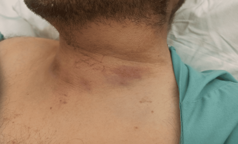 Thyroid Rupture and Haematoma: A Case Report on Successful Conservative Management