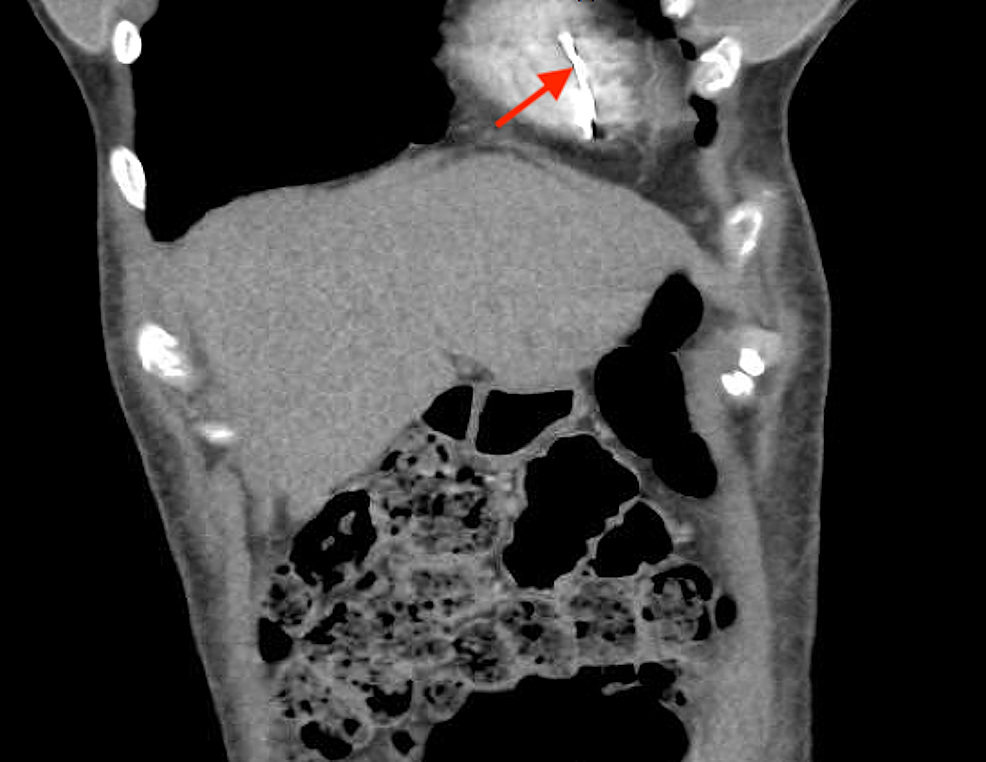 A Fractured Inferior Vena Cava Strut Migrating To The Right Ventricle ...