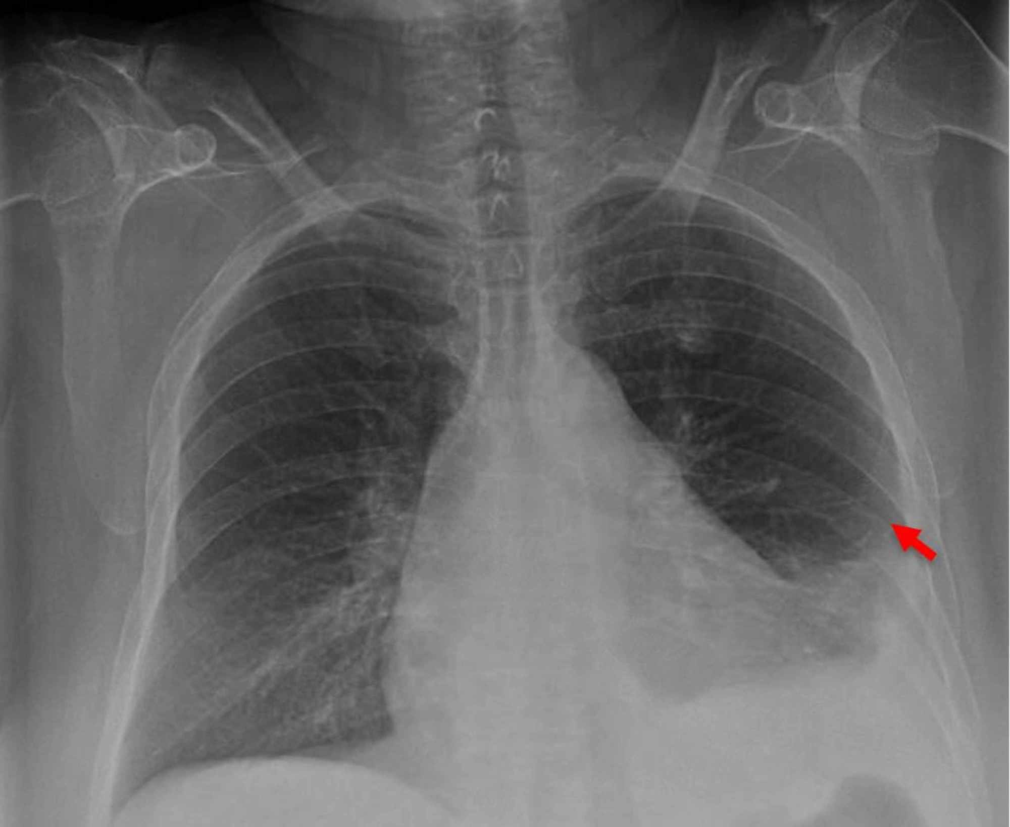 Pleural Effusion On X Ray Vrogue Co