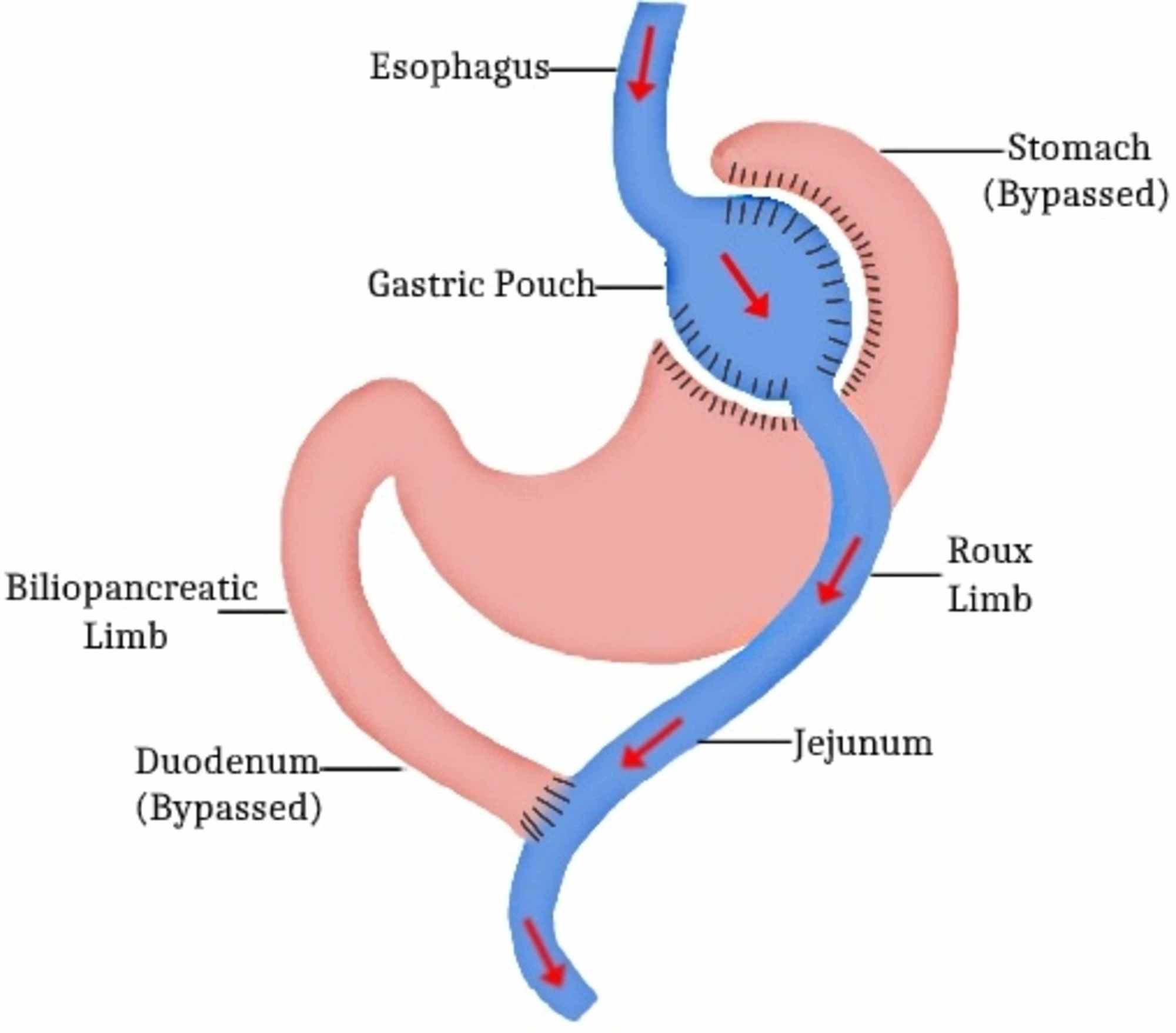 Cureus | Bariatric Surgery and Type 2 Diabetes Mellitus: Assessing ...